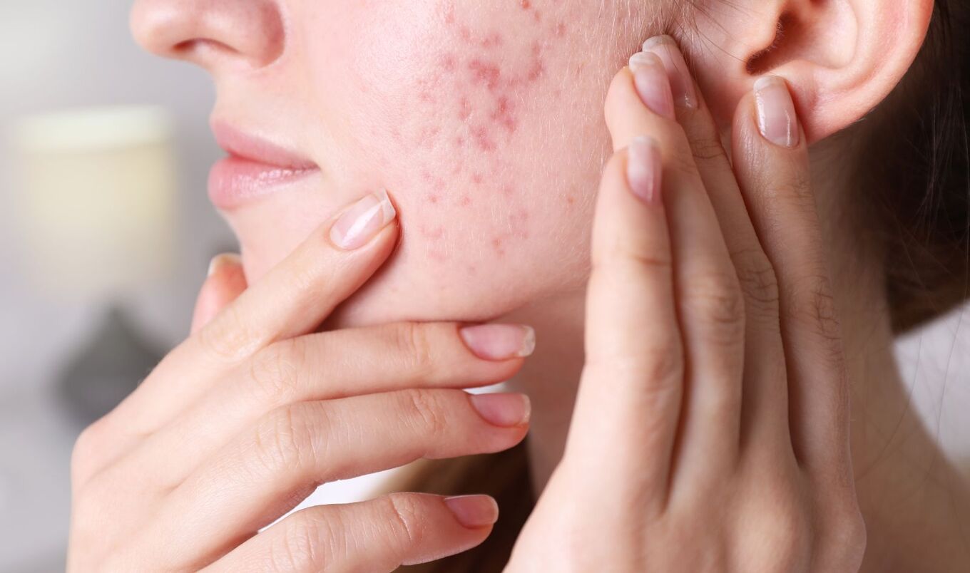 woman with acne